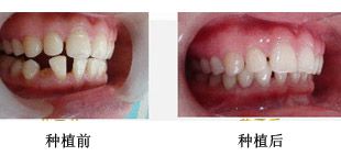 牙齿矫正典型案例