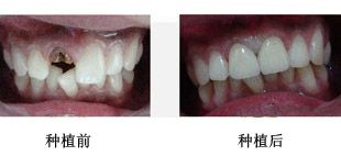 牙齿矫正典型案例