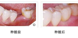 牙齿矫正典型案例