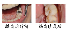 郑州唯美蛀牙治疗案例