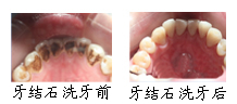 郑州唯美牙结石护理案例