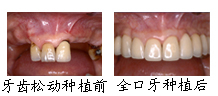 郑州唯美牙齿松动种植案例