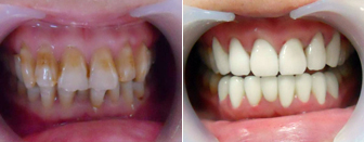 牙齿美白前后对比图