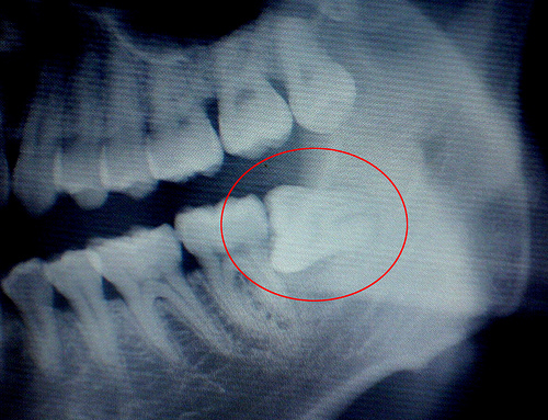 智齿一定要拔掉吗