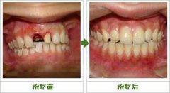 郑州牙龈萎缩能种植牙吗