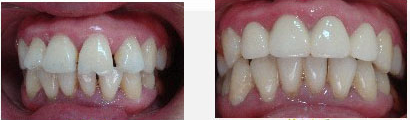 成人牙齿稀疏快速修复的方法