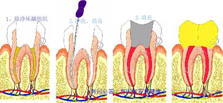 郑州牙根管治疗费用