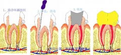 牙痛需要做根管治疗吗