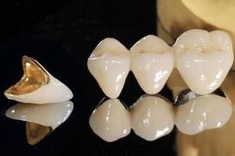 全瓷牙修复牙齿的过程