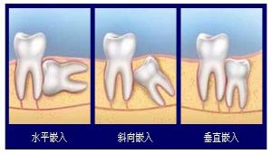 长智慧牙需要拔除吗