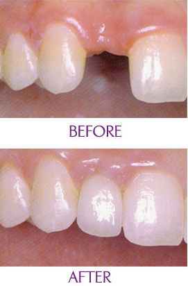 植一颗牙要多少钱 植一颗牙要多少钱