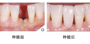 种颗门牙要多少钱