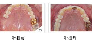 缺几颗牙齿可以补上吗,