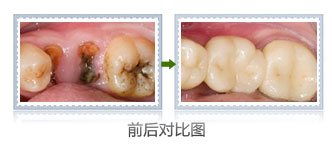 蛀牙影响换牙么