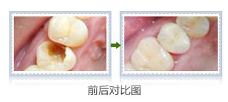 三岁孩子有蛀牙怎么办