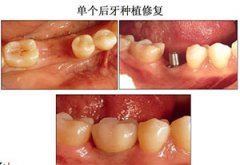 郑州口腔医院种植牙，点击即刻了解