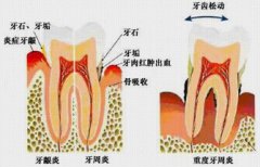 牙龈萎缩能做种植牙吗？